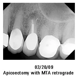 02/20/09 Apicoectomy with MTA retrograde