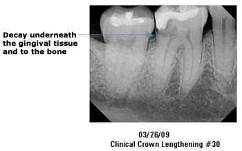 03/26/09 Clinical Crown Lengthening #30