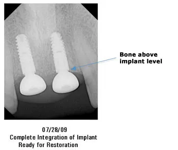07/28/09 Complete Integration of Implant Ready for Restoration