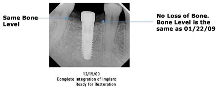 12/15/09 Complete Integration of Implant Ready for Restoration