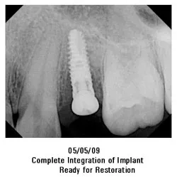 05/05/09 Complete Integration of Implant Ready for Restoration