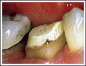 Crown Lengthening