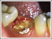 Decayed Tooth Before Crown