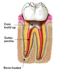 Post and Core Build-Up