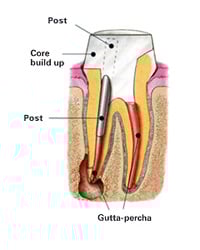 Post and Core Build-Up