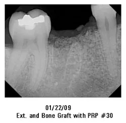 01/22/09 Ext. and Bone Graft with PRP #30