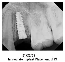01/23/09 Immediate Implant Placement #13