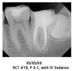 05/05/09 RCT #18, P&C, with IV Sedation