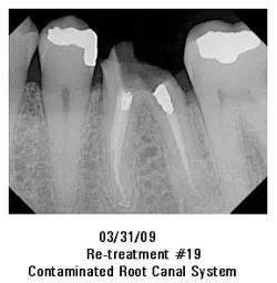 03/31/09 Re-treatment #19 Contaminated Root Canal System