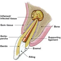 Apicoectomy