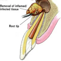Apicoectomy