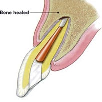 Apicoectomy