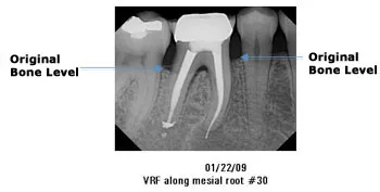 01/22/09 VRF along mesial root #30