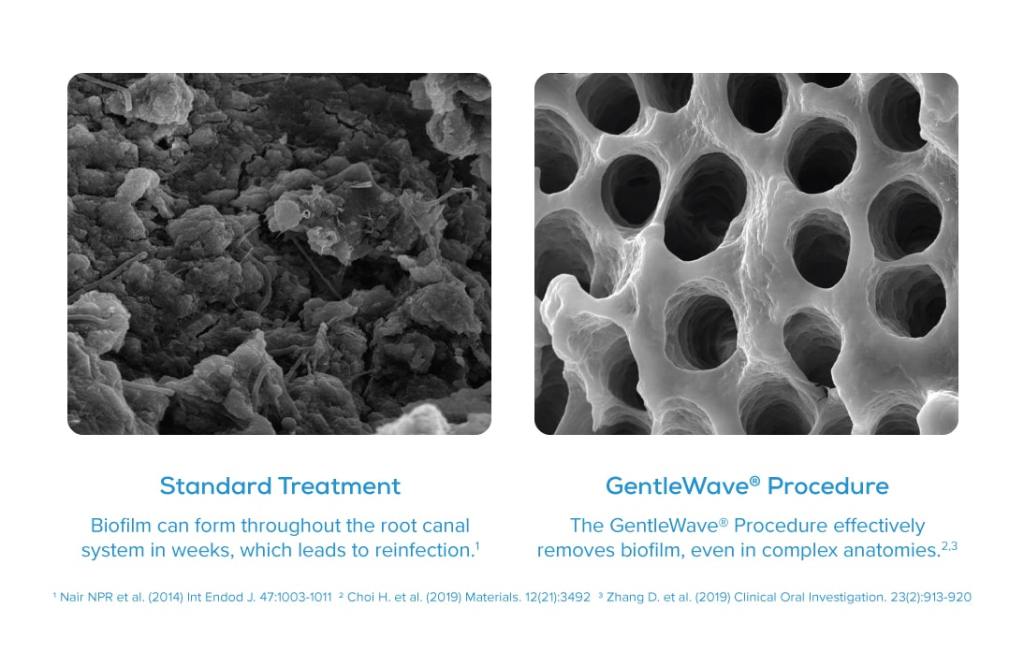 Two SEM images: left “Standard Treatment” reveals granular, particle-laden surface; right “GentleWave® Procedure” shows smooth, homogeneous texture with efficacy note