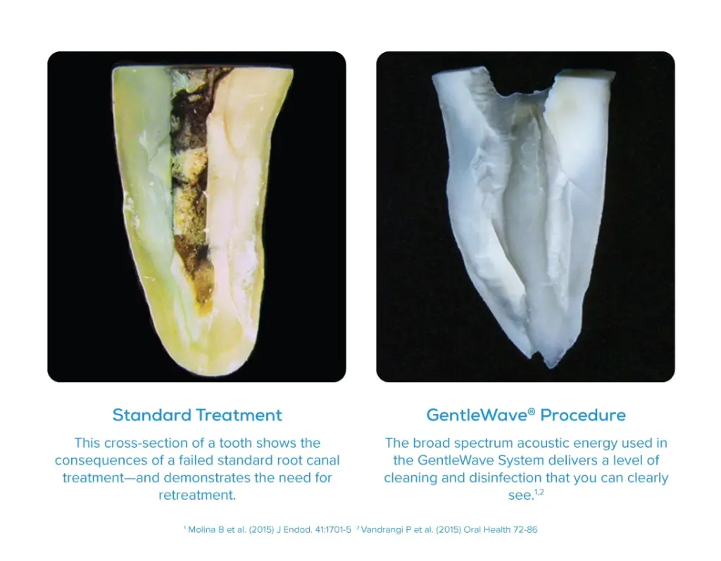 GentleWave® Root Canal Therapy | Bay Area Endodontics