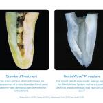 Side-by-side tooth cross-sections: left labeled “Standard Treatment” shows debris; right “GentleWave® Procedure” shows cleaner canal with caption on biofilm removal